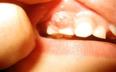 Tooth Abscesses